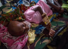 A Papuan child suffering from malnutrition lies in a hospital bed for treatment in Agats, the capital of Asmat district in Indonesia's easternmost Papua province, on January 26, 2018. Some 800 children have been sickened in the area with as many as 100 others, mostly toddlers, feared to have died in what a military official called an "extraordinary" outbreak that was first made public this month. AFP/ Bay Ismoyo