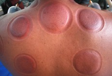 A patient shows the welts on his back after therapy. JP/Boy T. Harjanto